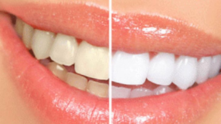 Doğal yollarla diş beyazlatmak mümkün