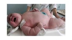 18 kilo doğan bebek doktorları şaşırttı